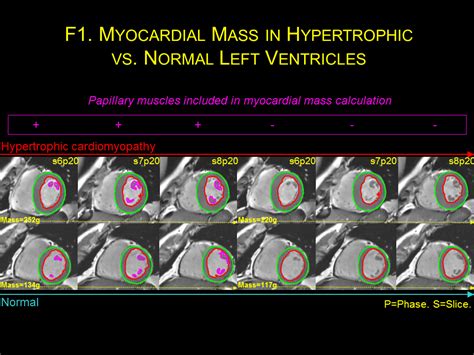 what is normal myocardial mass